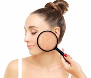 Dr. Tatiana Khrom and her professional staff can assist men and women who have been diagnosed with rosacea on ways to keep the redness and flushing under control.