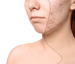 Get Rid of Acne Scars Dyker Heights in Brooklyn, NY area