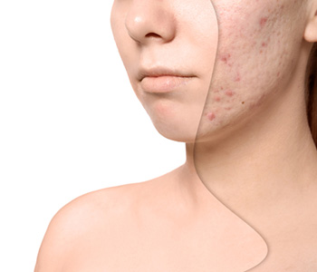 Major survey spotlights novel factors influencing acne