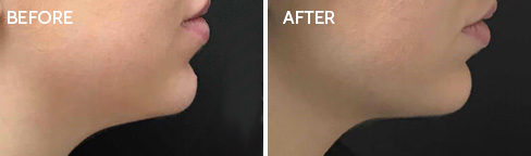 Coolsculpting Before after07