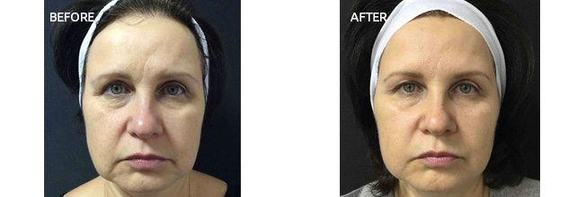 Actual Patient Before and After Images 4