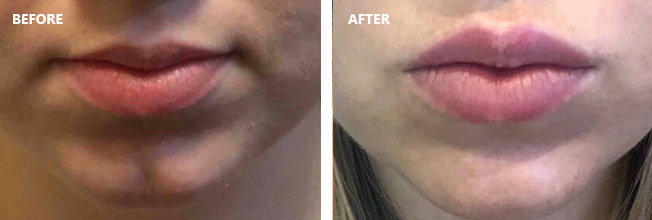 Before and After Actual Patient of Juvéderm