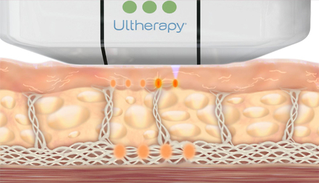 How Ultherapy Stimulates Collagen Production at Different Layers Skin Tightening