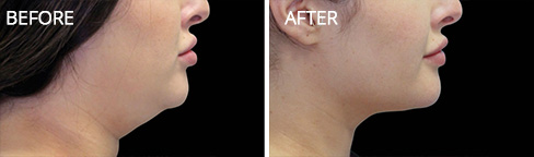 Coolsculpting Before after01