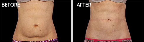 Coolsculpting Before after 03