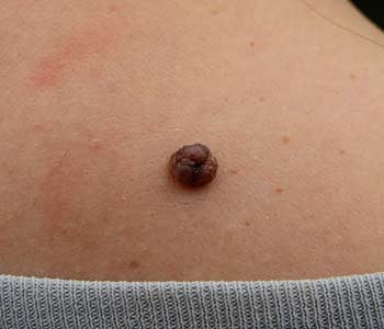 Warts behind the neck of Women