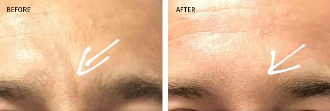 Botox is Safe, Before and After