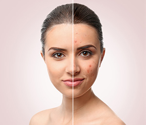 Before and after image of a girl with acne