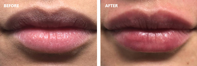 Juvederm Before and After 1