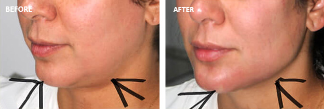 Juvederm Before and After 4