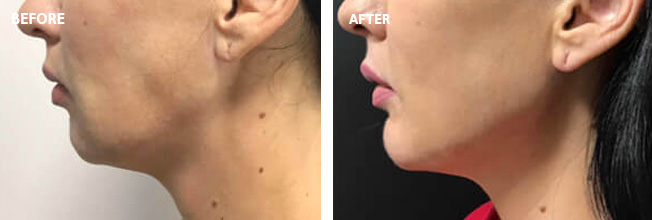 Juvederm Before and After 6