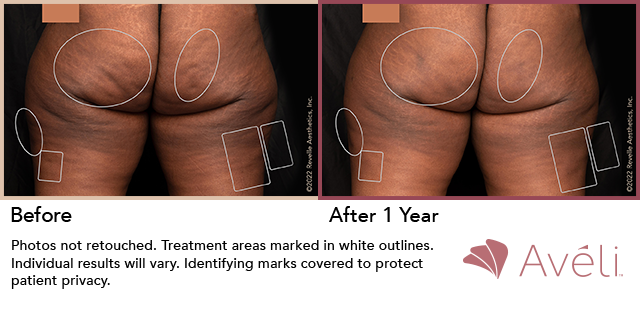 Before and After Treatment Images, Aveli, 002
