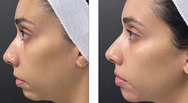 Non-Surgical Rhinoplasty - Before and After Results